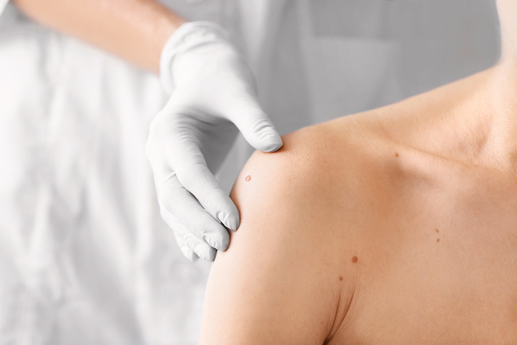 What Are Skin Tags? Understanding Causes and Treatments of Skin Tags with Dermatologist Dr Ne Win